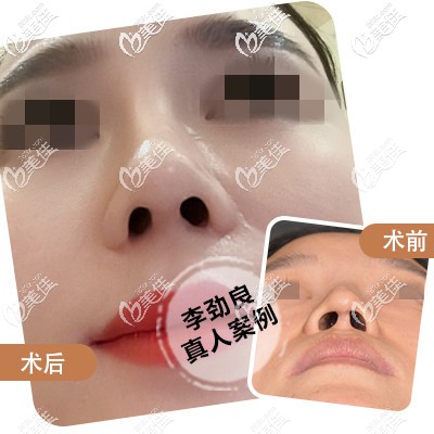 李劲良院长鼻小柱整形案例