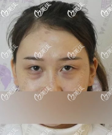 赤峰紫洁叶子整形刘文峰院长不开刀去眼袋前 赤峰紫洁叶子整形刘文峰院长不开刀去眼袋前