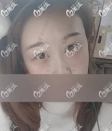 赤峰紫洁去眼袋第二天 赤峰紫洁去眼袋第二天