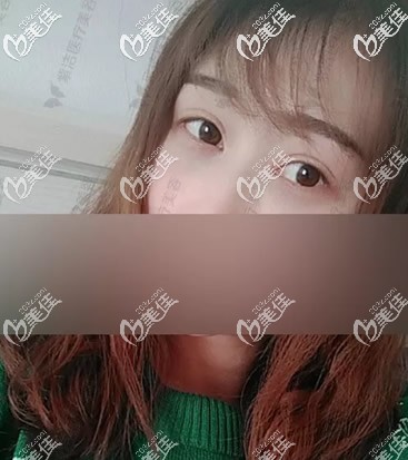 无痕去眼袋+自体脂肪填充泪沟第十天效果 无痕去眼袋+自体脂肪填充泪沟第十天效果