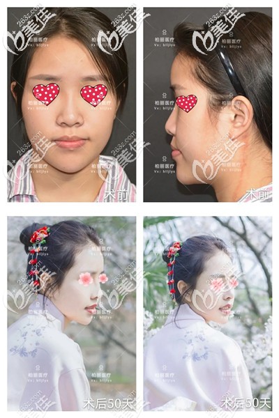 找李劲良医生隆鼻前后对比