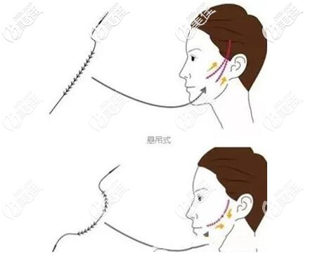 埋线提升的埋入位置 埋线提升的埋入位置