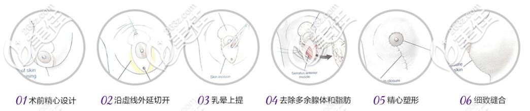 垂直切口法乳房缩小术示意图 垂直切口法乳房缩小术示意图