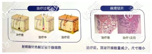 黄金微针治疗狐臭的原理和效果 黄金微针治疗狐臭的原理和效果