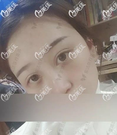 赤峰紫洁刘文峰不开刀去眼袋第3天 赤峰紫洁刘文峰不开刀去眼袋第3天