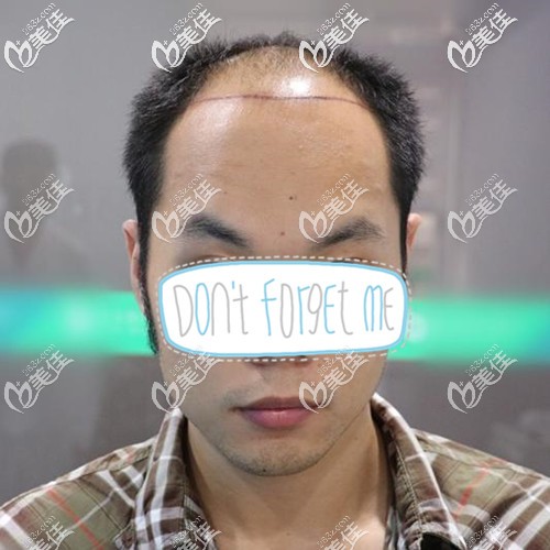 头顶头发稀疏加密术前照片 头顶头发稀疏加密术前照片