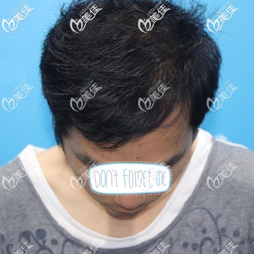 还在质疑广州倍生植发靠不靠谱?那就来看看我头发加密种植4000毛囊单位后的效果吧