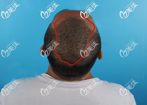 头发加密手术术后8天效果 头发加密手术术后8天效果