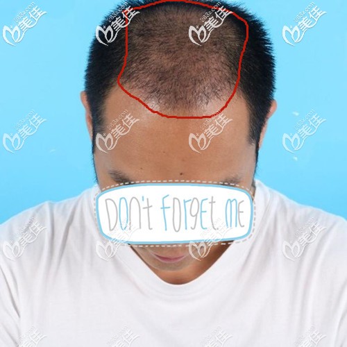 广州倍生头发加密种植一个月效果 广州倍生头发加密种植一个月效果