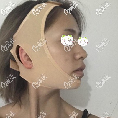 做颧骨整形半个月后还戴着头套
