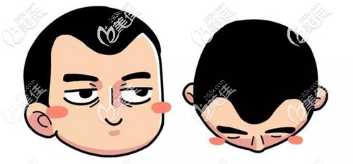 m型脱发、发际线后移 m型脱发、发际线后移