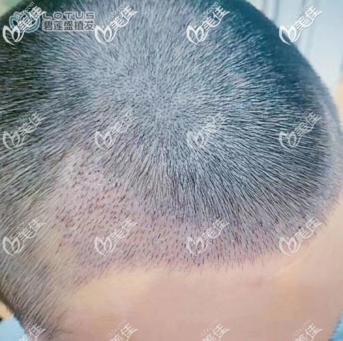 发际线种植术后5天效果图 发际线种植术后5天效果图