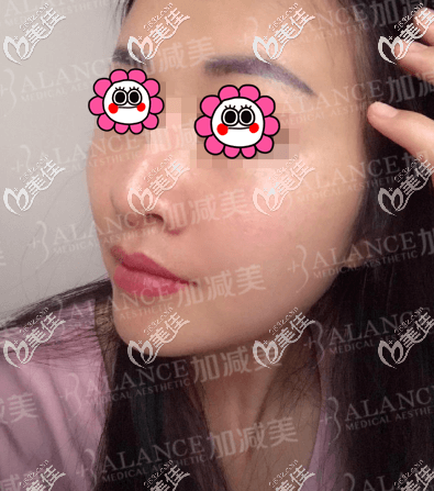 做V美减龄 V6复位青春术第7天 做V美减龄 V6复位青春术第7天