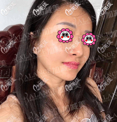 做V美减龄提升抗衰一个月样子 做V美减龄提升抗衰一个月样子