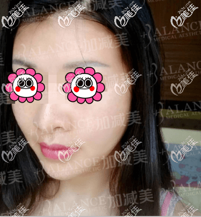 做V6复位青春术5个月了 做V6复位青春术5个月了