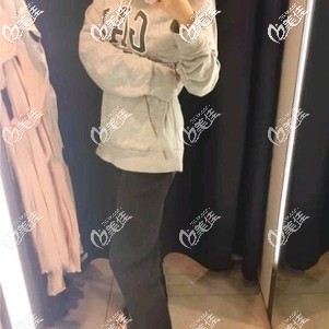 吸脂瘦大腿术后32天肿胀渐消