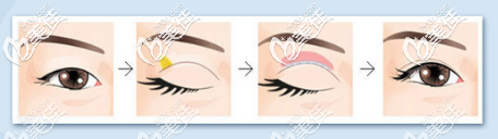 深圳瑞芙臣刘颜颜医生双眼皮手术过程演示