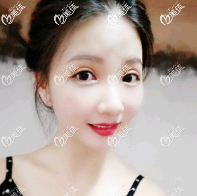 深圳瑞芙臣刘颜颜医生双眼皮术后4天效果