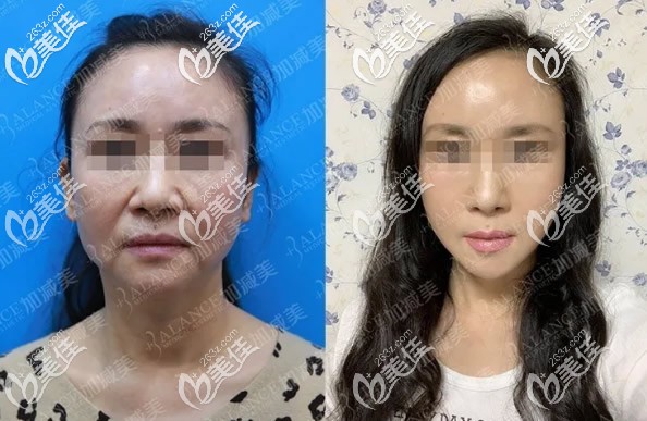 北京加减美穆宝安面部提升效果案例 北京加减美穆宝安面部提升效果案例