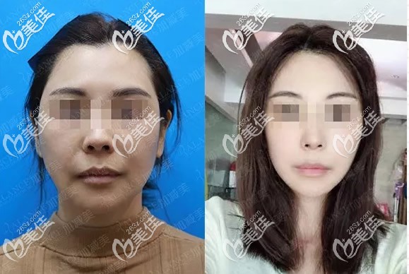 加减美v6提升一个月效果图 加减美v6提升一个月效果图