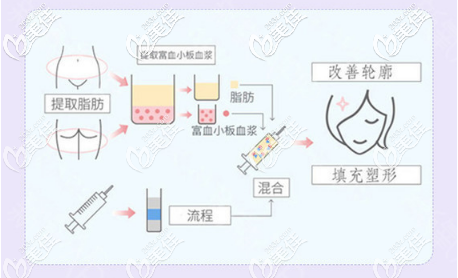 脂肪填充原理图 脂肪填充原理图