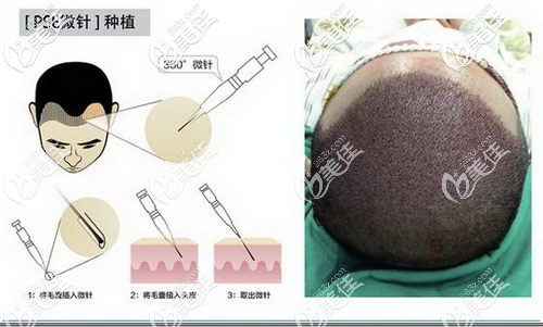 微针植发原理及效果展示 微针植发原理及效果展示
