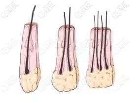 一个毛囊里有1-4根头发