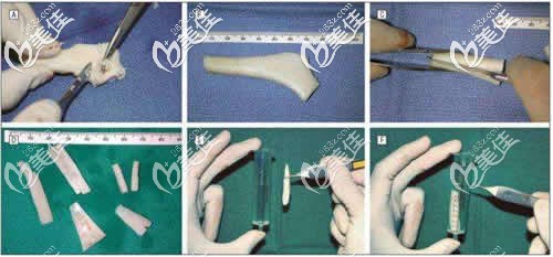 异体骨隆鼻雕刻过程示意图
