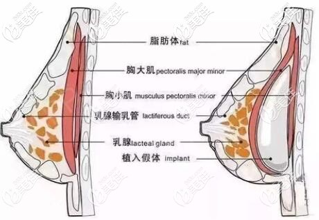 假体隆胸手术剥离位置 假体隆胸手术剥离位置