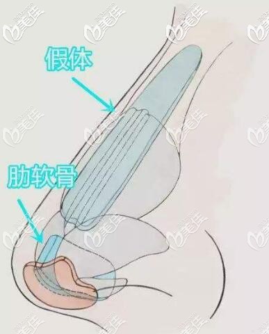 半肋骨隆鼻常见的手术方法