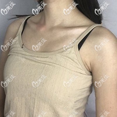 做乳房整形前我是平胸妹子一枚 做乳房整形前我是平胸妹子一枚