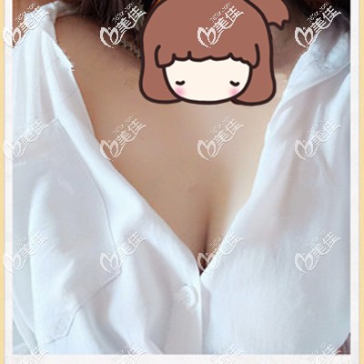 术后一个月恢复的不错 术后一个月恢复的不错