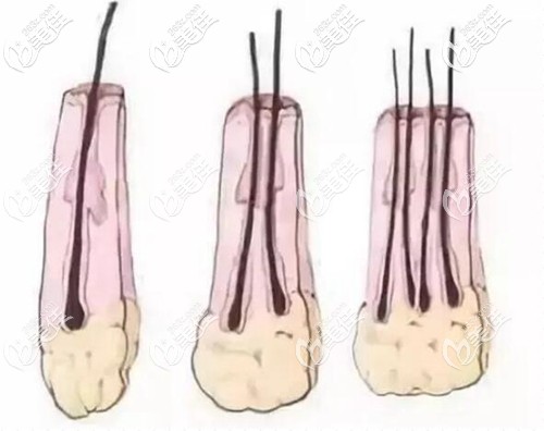 提取毛囊组织的形态