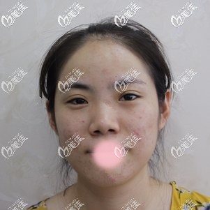 术前满脸痘痘 术前满脸痘痘