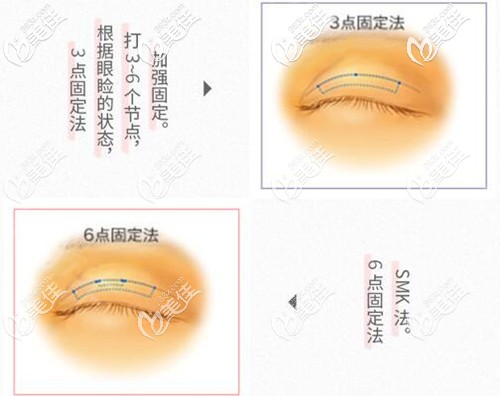 永井医生的埋线双眼皮和传统埋线法的区别 永井医生的埋线双眼皮和传统埋线法的区别