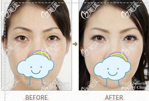 术前单眼皮选择埋线做平行双眼皮 术前单眼皮选择埋线做平行双眼皮