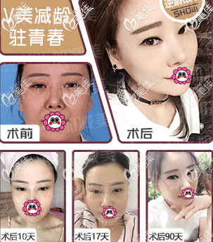 我找北京加减美黄寅守做V美减龄v6面部提升效果