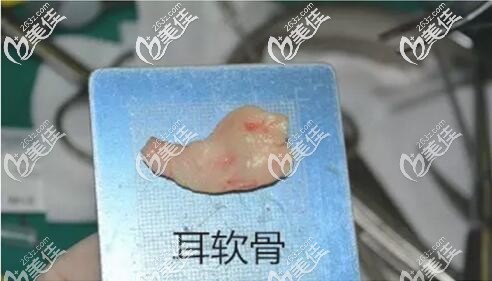 取下来的耳软骨 取下来的耳软骨