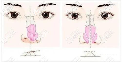 歪鼻矫正手术原理 歪鼻矫正手术原理