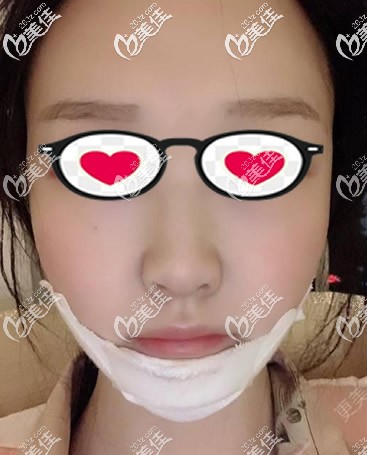 硅胶垫下巴第1天摸着很僵硬