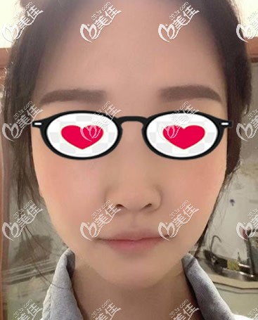 硅胶假体垫下巴第十天拆线后图片