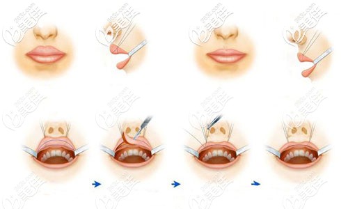 厚唇改薄手术过程