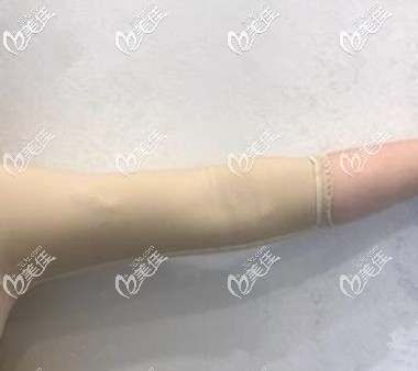泰国手臂吸脂术后1周效果图