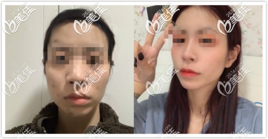 太原刘晋元肋软骨隆鼻6个月效果对比照片 太原刘晋元肋软骨隆鼻6个月效果对比照片