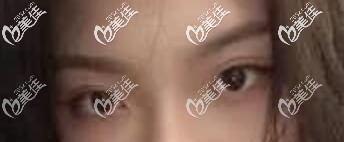 苏州康美整形张悦迪双眼皮真人案例