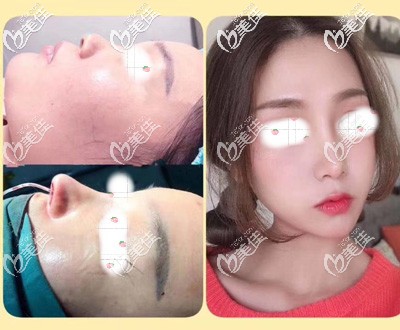 詹院长做鼻综合术前术后即刻对比 詹院长做鼻综合术前术后即刻对比