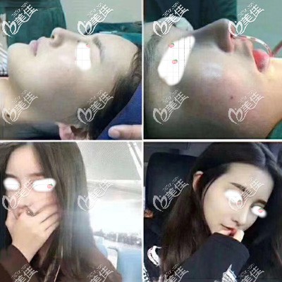 朝天鼻做鼻综合术后45天恢复效果 朝天鼻做鼻综合术后45天恢复效果