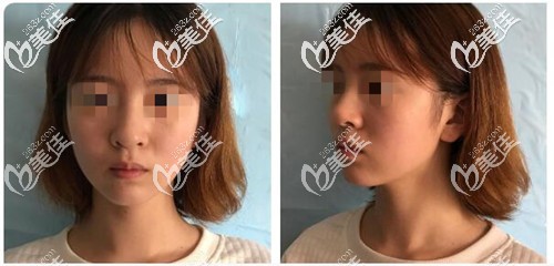 做自体软骨隆鼻手术前的样子 做自体软骨隆鼻手术前的样子