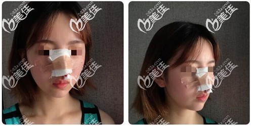 手术后第二天鼻子绑着纱布 手术后第二天鼻子绑着纱布