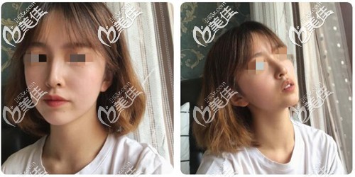 自体肋软骨隆鼻半个月恢复效果 自体肋软骨隆鼻半个月恢复效果